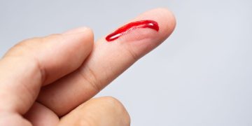 ngón tay bị chảy máu