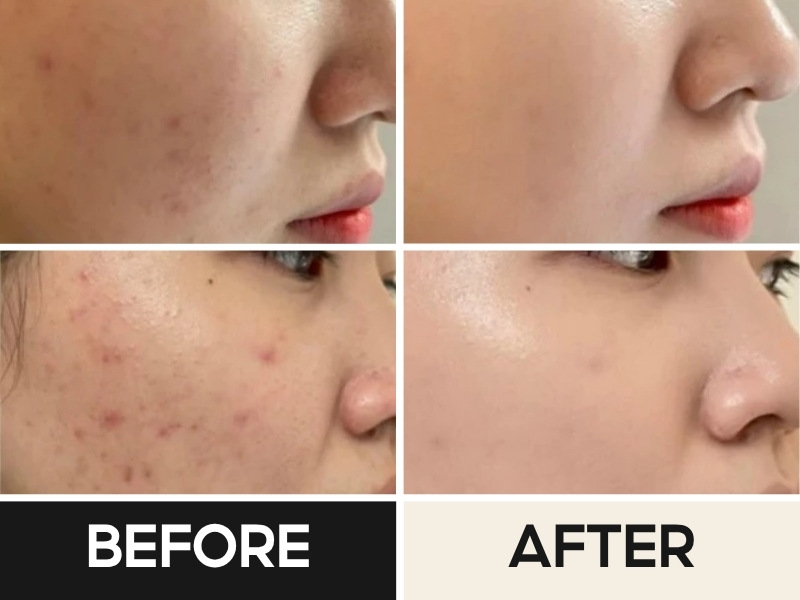 Trước và sau khi đánh Renoderm Day Long BB Cream