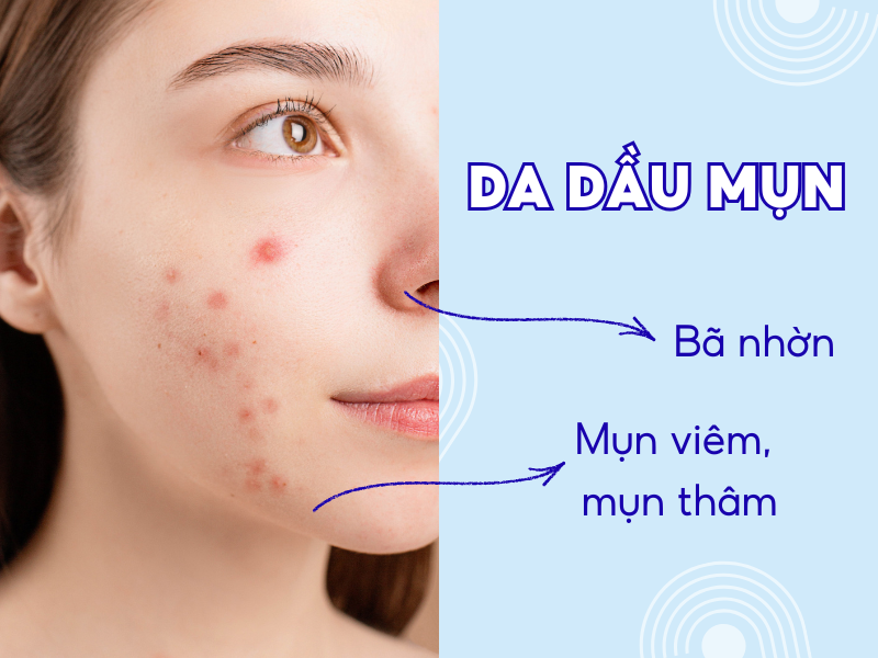 Da dầu mụn thường có nhiều bã nhờn, mụn viêm, mụn thâm 