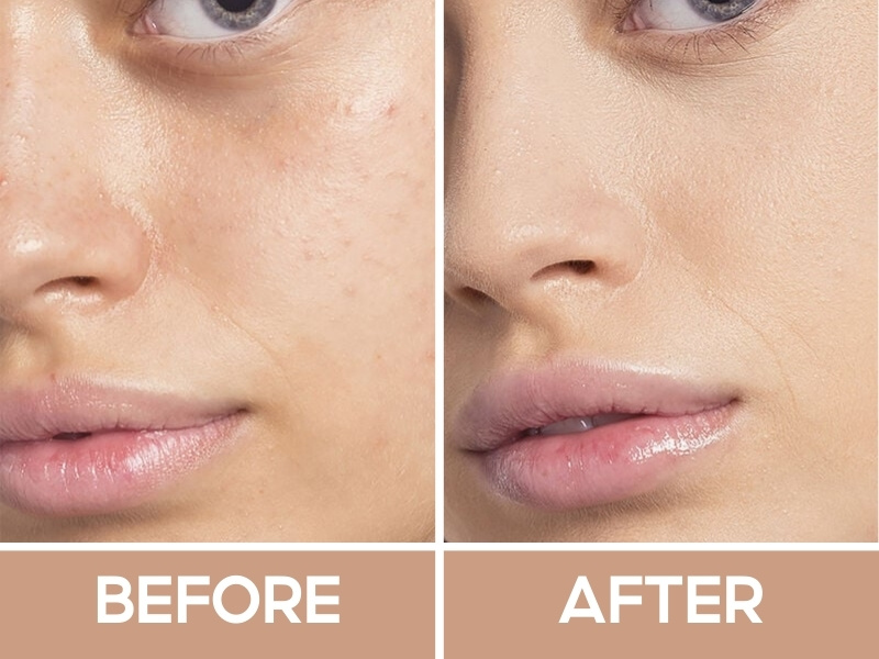 Trước và sau khi đánh Make Up For Ever HDSkin