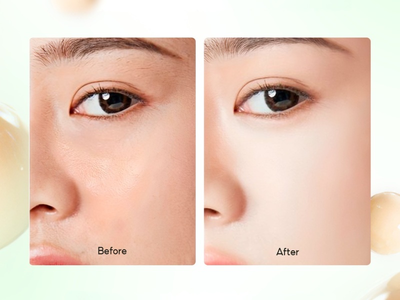 Trước và sau khi đánh Naris Ailus Stress Free