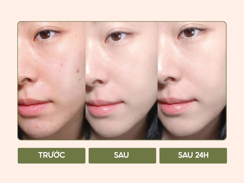 Glamrr Q Vegan Super Glow Cushion trên da dầu mụn