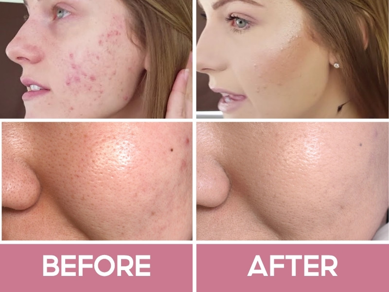 Trước và sau khi đánh kem nền Lancome Teint Idole