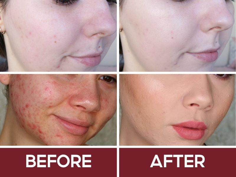 Trước và sau khi đánh BB Cream Missha