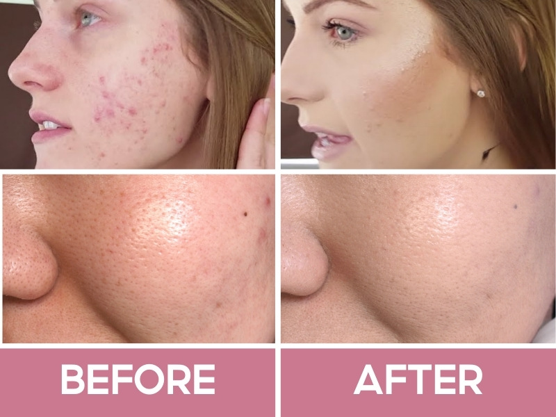 Trước và sau khi dùng kem nền chống nắng Lancome