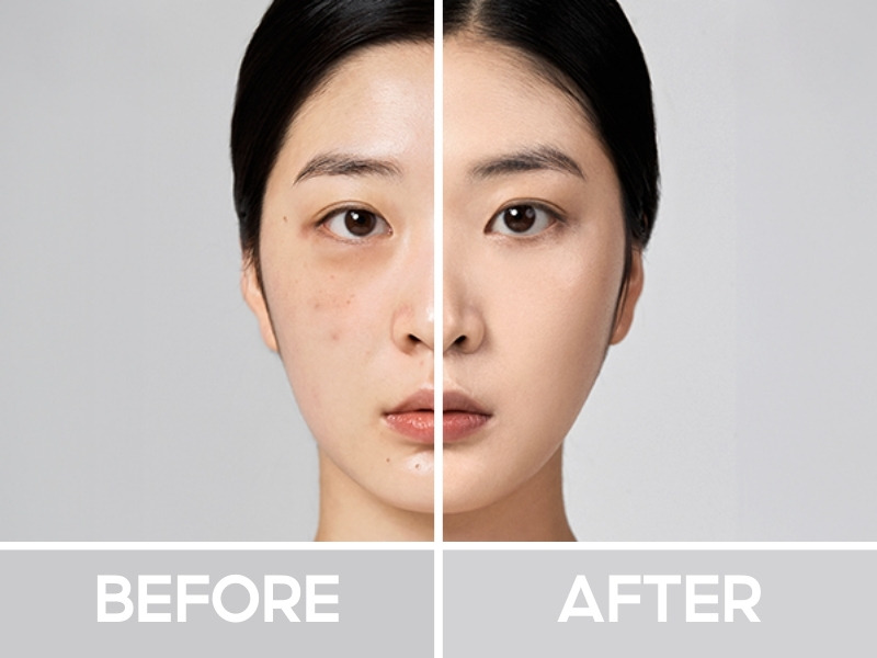 Trước và sau khi đánh che khuyết điểm TFIT