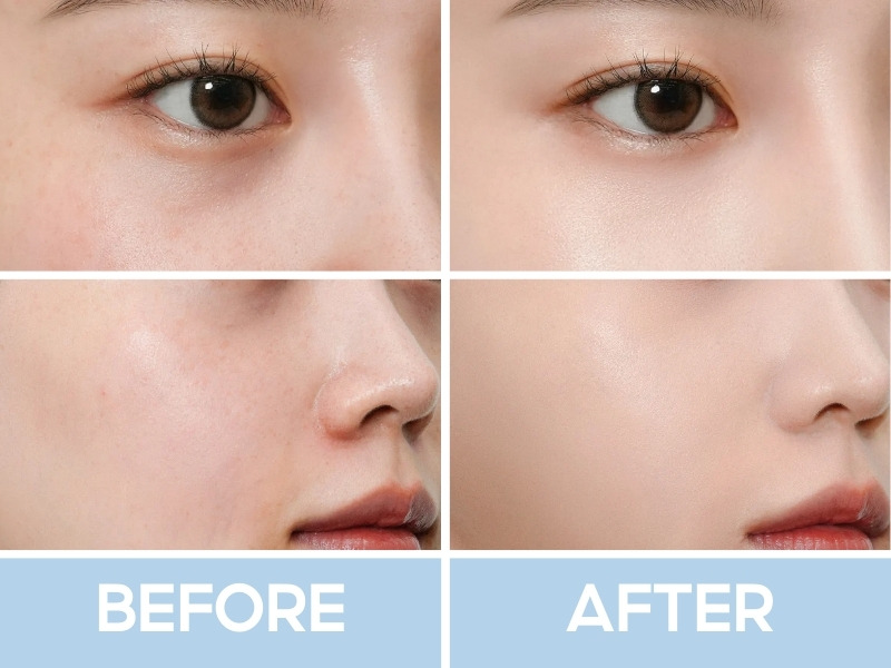 Trước và sau khi đánh che khuyết điểm Clio