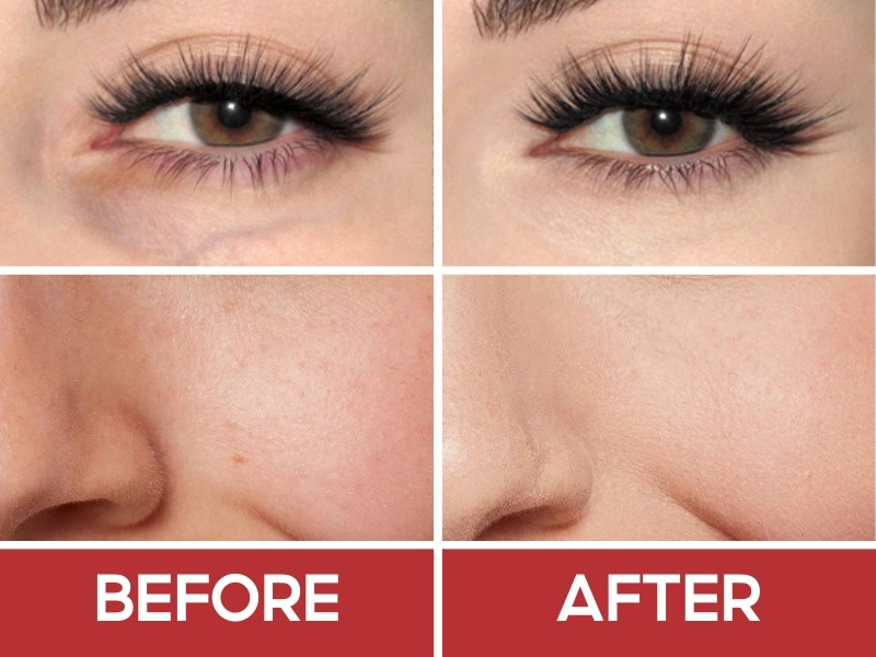 Trước và sau khi đánh che khuyết điểm L'Oreal Paris