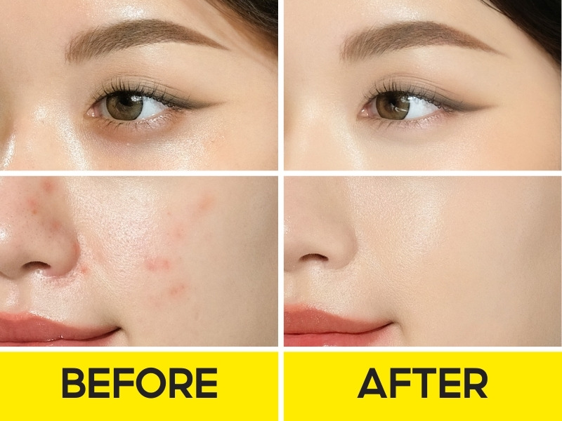 Trước và sau khi đánh che khuyết điểm Lemonade