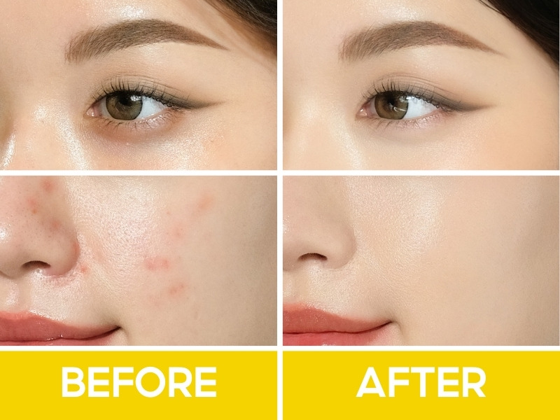 Trước và sau khi đánh che khuyết điểm Lemonade