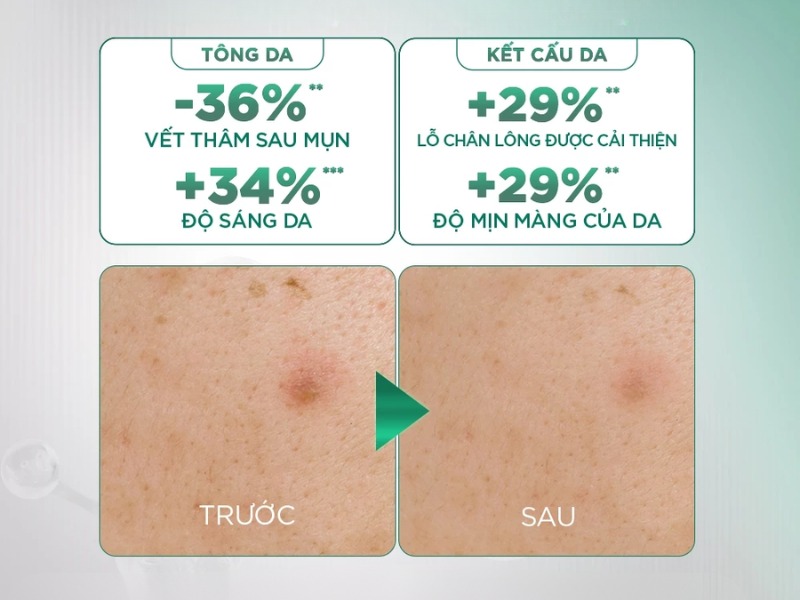Serum Tri-Acid của Garnier