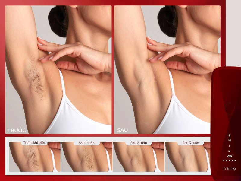 Hiệu quả thực tế máy triệt lông Halio SilkGlow IPL