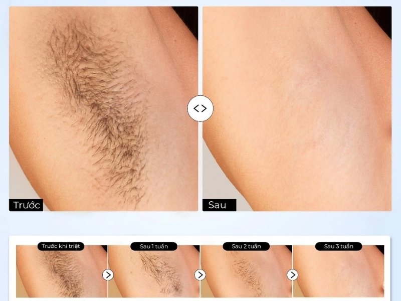 Hiệu quả thực tế máy triệt lông Halio SilkGlow IPL