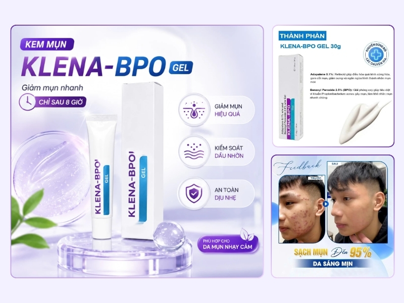 Gel trị mụn Klena Adapalene