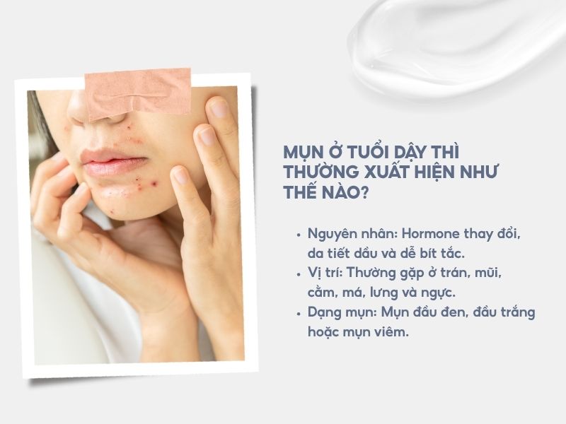 Mụn ở tuổi dậy thì thường xuất hiện như thế nào?