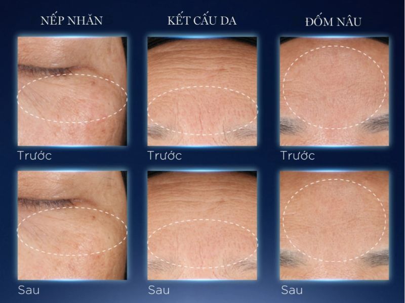 Hiệu quả thực tế serum Lancôme Génifique